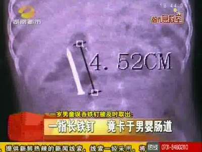 一指长铁钉 竟卡于男婴肠道