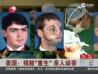 [视频]毁容男子全脸移植获重生 与捐献者姐姐深情拥抱