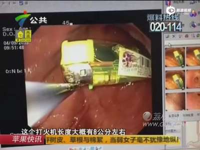 [视频]男子毒瘾发作生吞打火机 医生谨慎取出