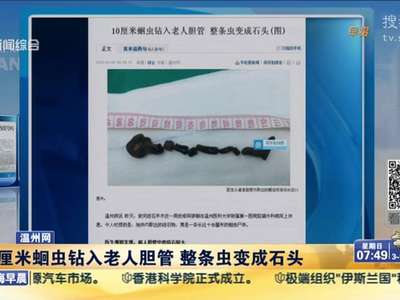 [视频]10厘米蛔虫钻入老人胆管 整条虫变成石头