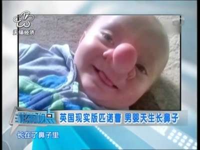 [视频]英国男婴天生大鼻子 似现实版匹诺曹吓坏妈妈