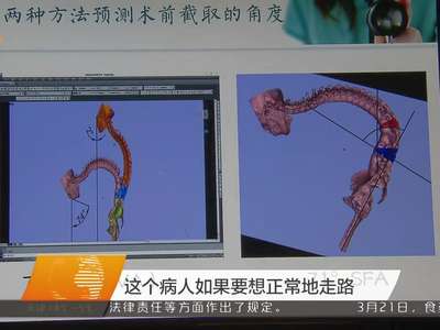 湘雅医院成功实施全国首例3D打印辅助脊柱截骨手术