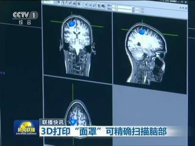 [视频]3D打印“面罩”可精确扫描脑部