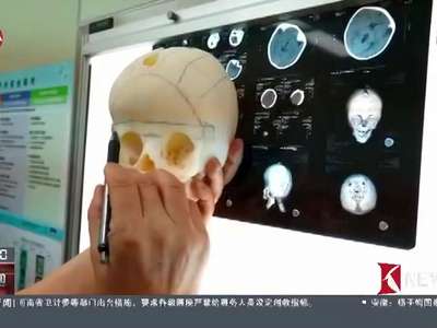 [视频]上海:3D打印重建“头骨拼图” 8月龄男婴狭颅症获矫治