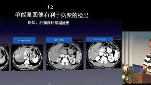 能谱基本原理和临床工具-刘华阳(下)