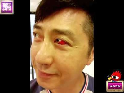 [视频]庾澄庆备战个唱压力大 眼球血管爆裂