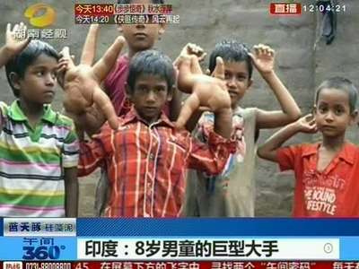 印度：8岁男童的巨型大手 一双手重大32斤 长达43厘米